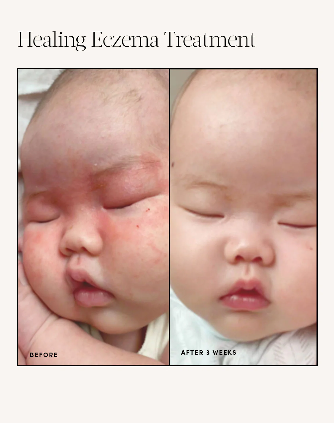 Healing Eczema Treatment - Image 8