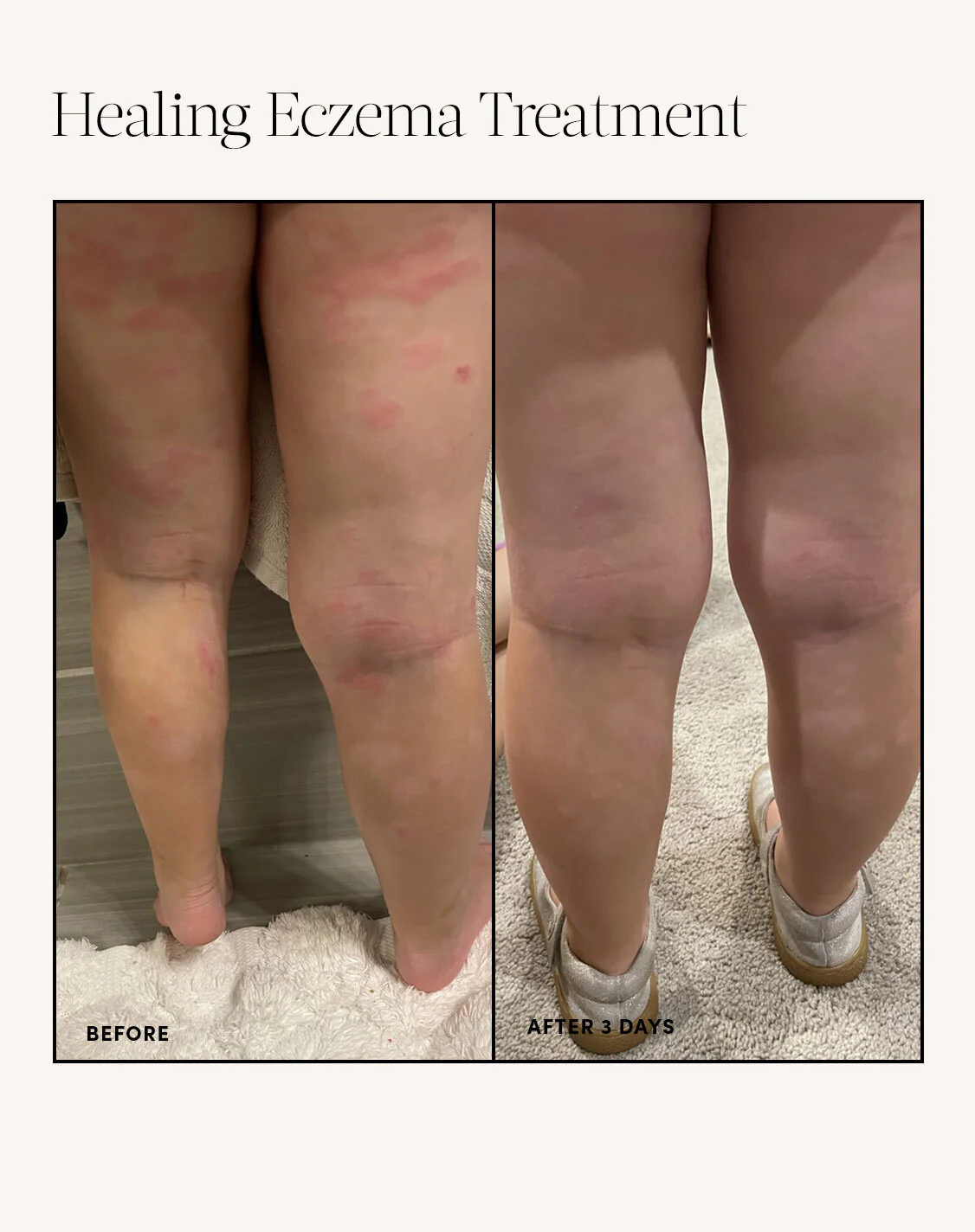 Healing Eczema Treatment - Image 9