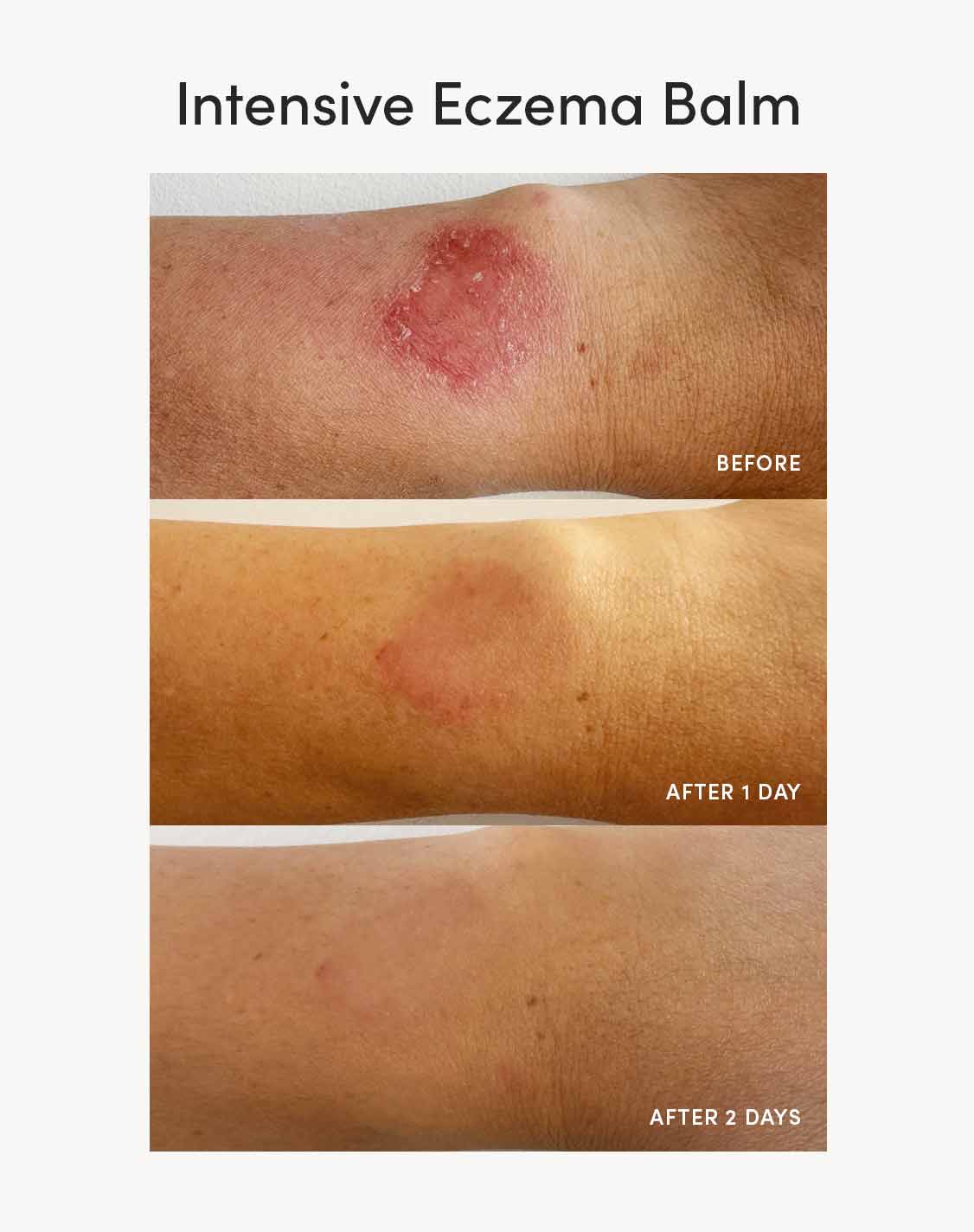 Intensive Eczema Balm - Image 3